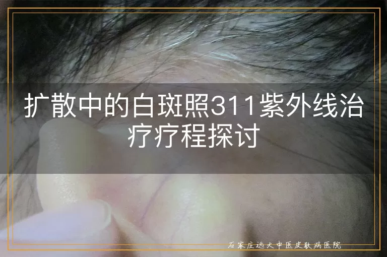 扩散中的白斑照311紫外线治疗疗程探讨