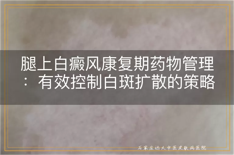 腿上白癜风康复期药物管理：有效控制白斑扩散的策略