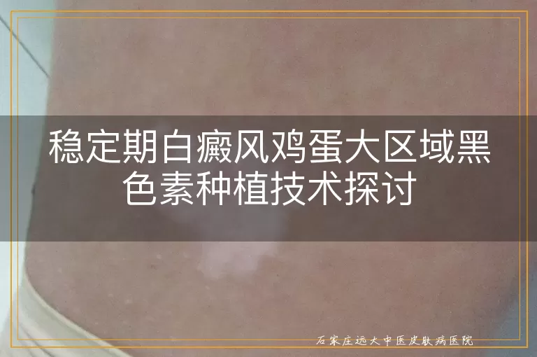 稳定期白癜风鸡蛋大区域黑色素种植技术探讨
