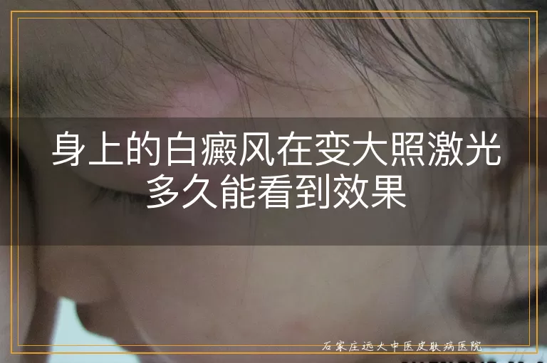 身上的白癜风在变大照激光多久能看到效果
