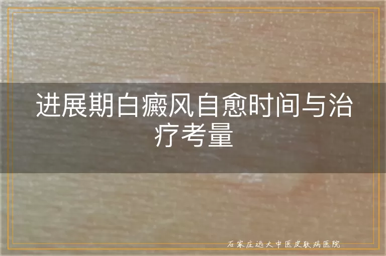 进展期白癜风自愈时间与治疗考量