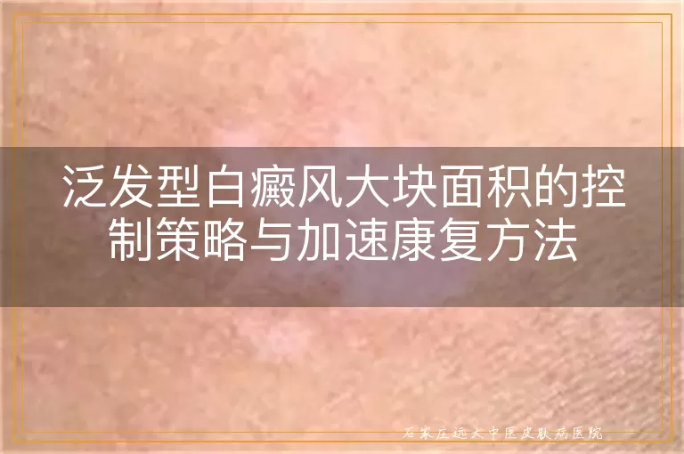 泛发型白癜风大块面积的控制策略与加速康复方法
