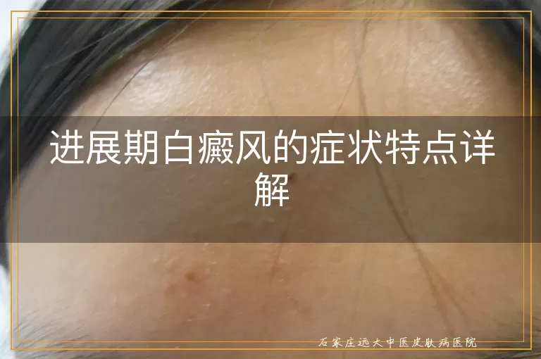 进展期白癜风的症状特点详解