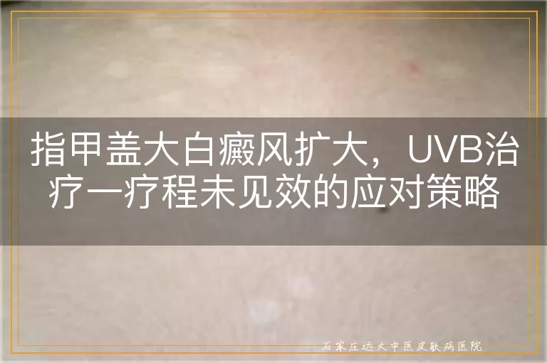 指甲盖大白癜风扩大，UVB治疗一疗程未见效的应对策略