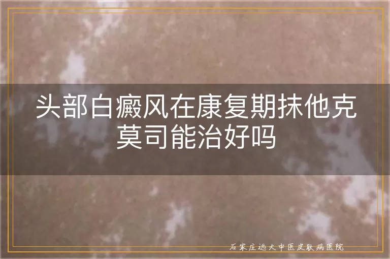 头部白癜风在康复期抹他克莫司能治好吗