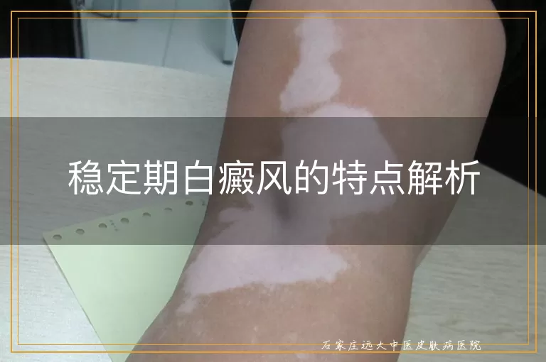 稳定期白癜风的特点解析