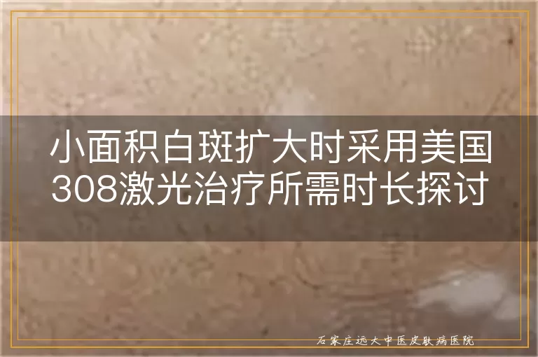 小面积白斑扩大时采用美国308激光治疗所需时长探讨