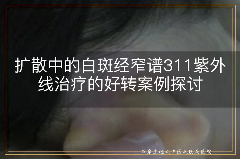 扩散中的白斑经窄谱311紫外线治疗的好转案例探讨