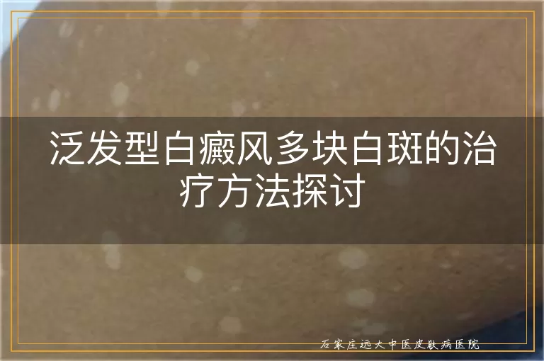 泛发型白癜风多块白斑的治疗方法探讨
