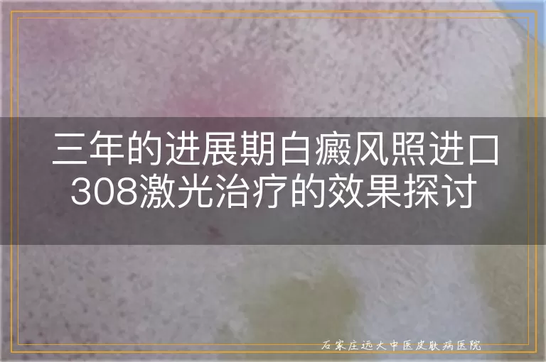 三年的进展期白癜风照进口308激光治疗的效果探讨