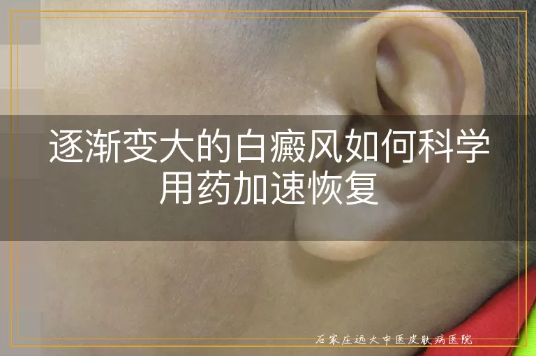 逐渐变大的白癜风如何科学用药加速恢复