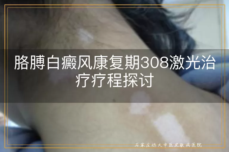 胳膊白癜风康复期308激光治疗疗程探讨