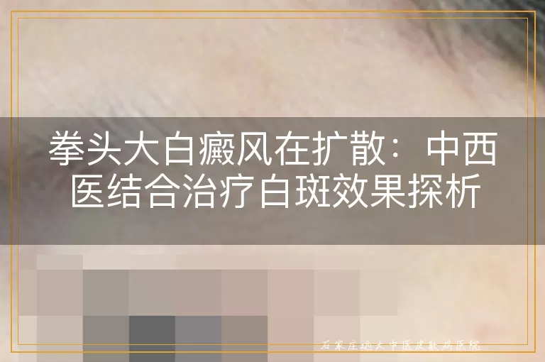 拳头大白癜风在扩散：中西医结合治疗白斑效果探析