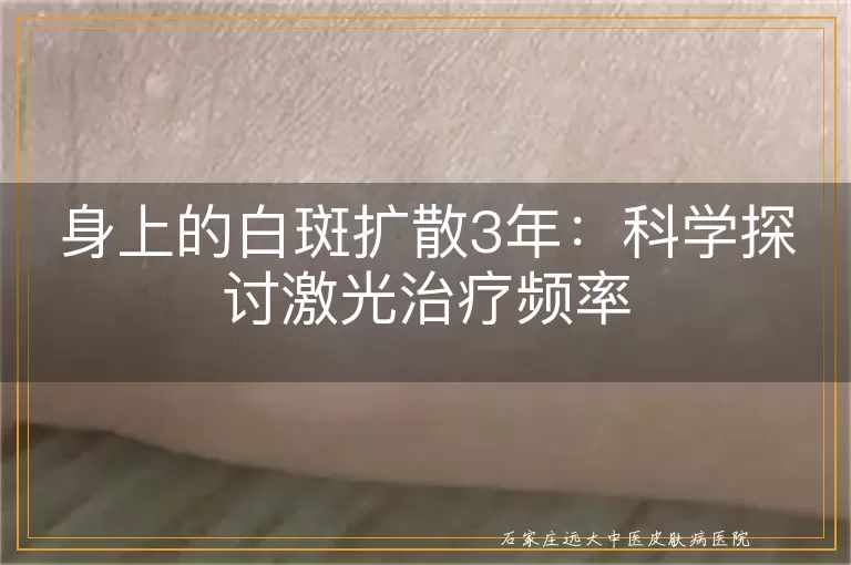 身上的白斑扩散3年：科学探讨激光治疗频率