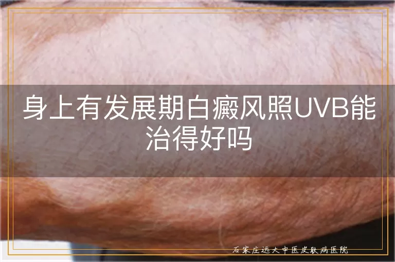 身上有发展期白癜风照UVB能治得好吗