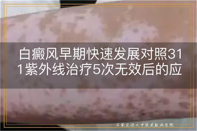 白癜风早期快速发展对照311紫外线治疗5次无效后的应对策略