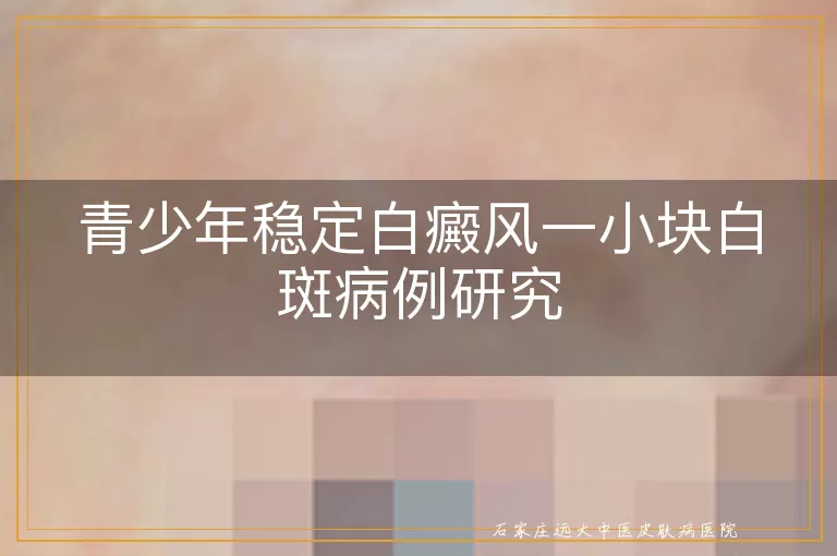 青少年稳定白癜风一小块白斑病例研究