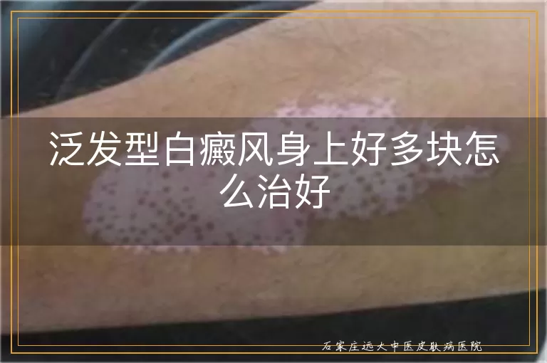 泛发型白癜风身上好多块怎么治好