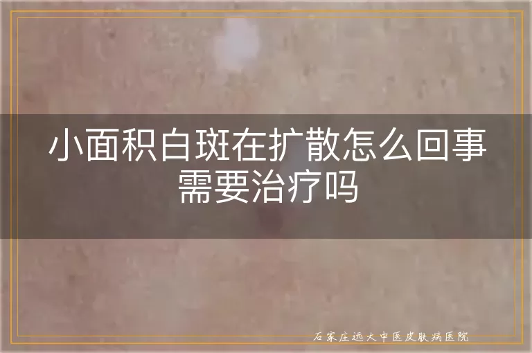 小面积白斑在扩散怎么回事需要治疗吗