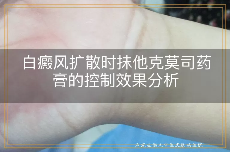 白癜风扩散时抹他克莫司药膏的控制效果分析