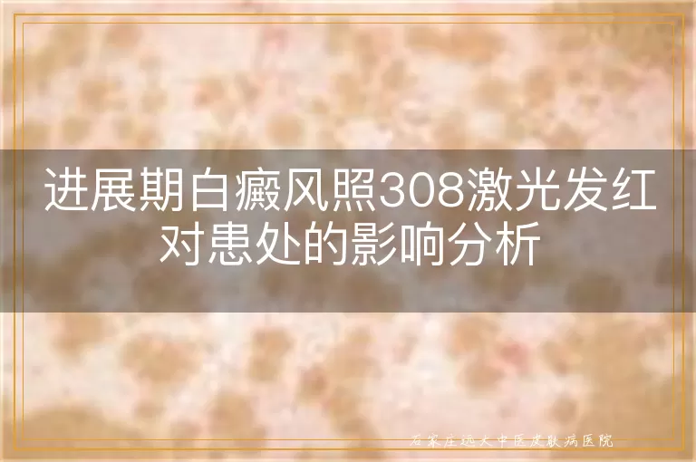 进展期白癜风照308激光发红对患处的影响分析