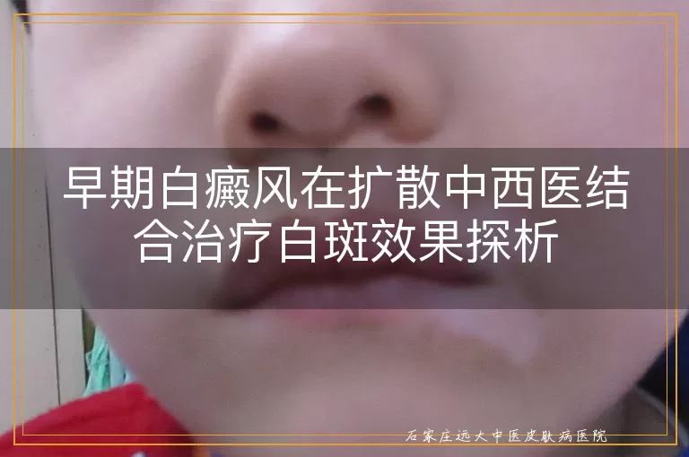 早期白癜风在扩散中西医结合治疗白斑效果探析