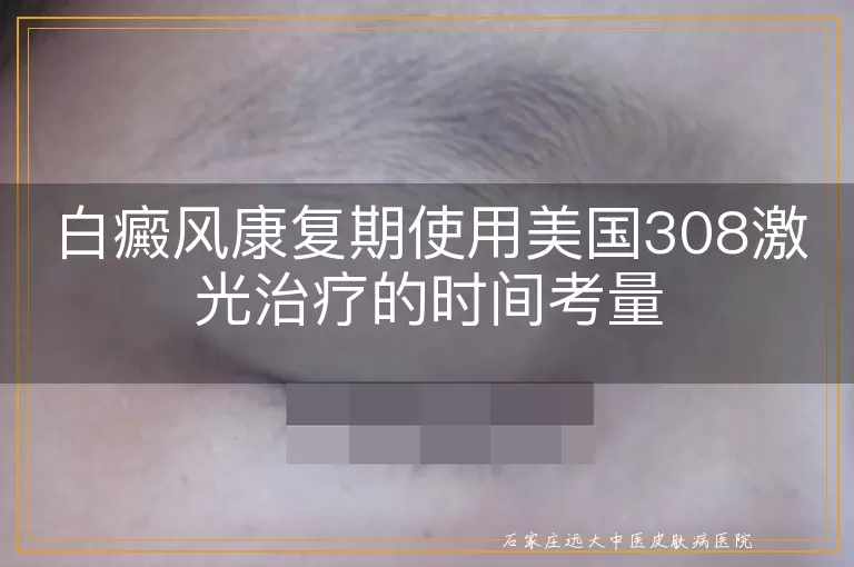 白癜风康复期使用美国308激光治疗的时间考量