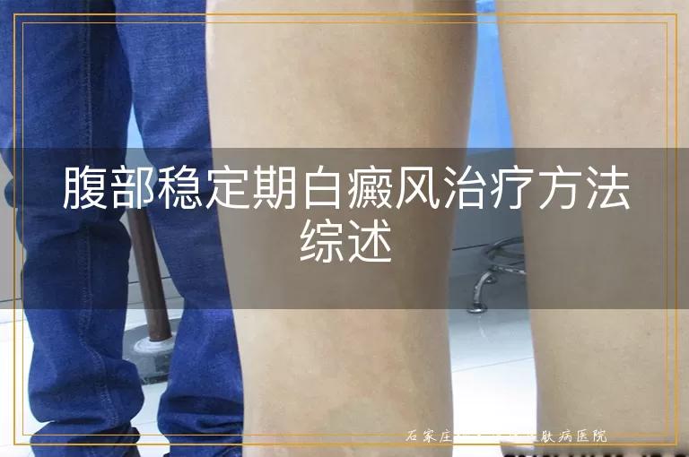 腹部稳定期白癜风治疗方法综述