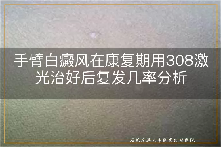 手臂白癜风在康复期用308激光治好后复发几率分析