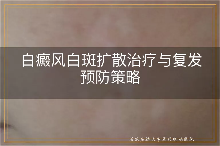 白癜风白斑扩散治疗与复发预防策略
