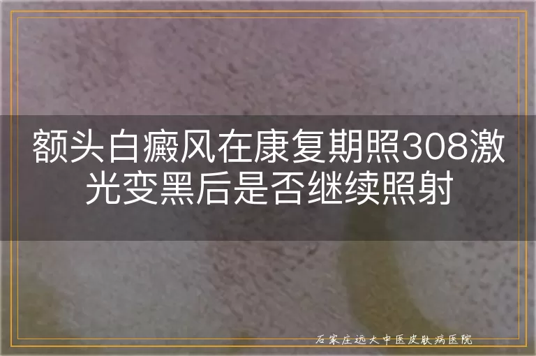 额头白癜风在康复期照308激光变黑后是否继续照射