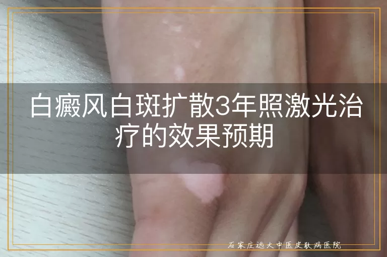 白癜风白斑扩散3年照激光治疗的效果预期