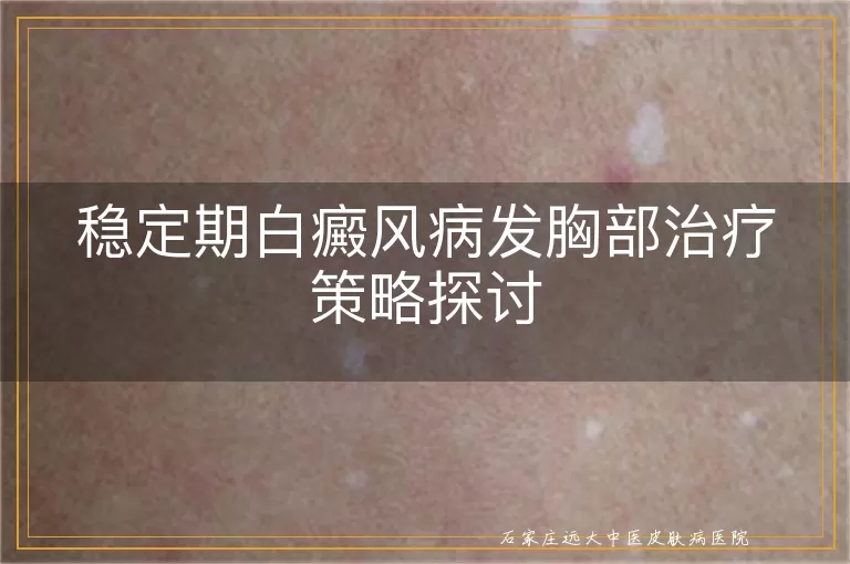 稳定期白癜风病发胸部治疗策略探讨