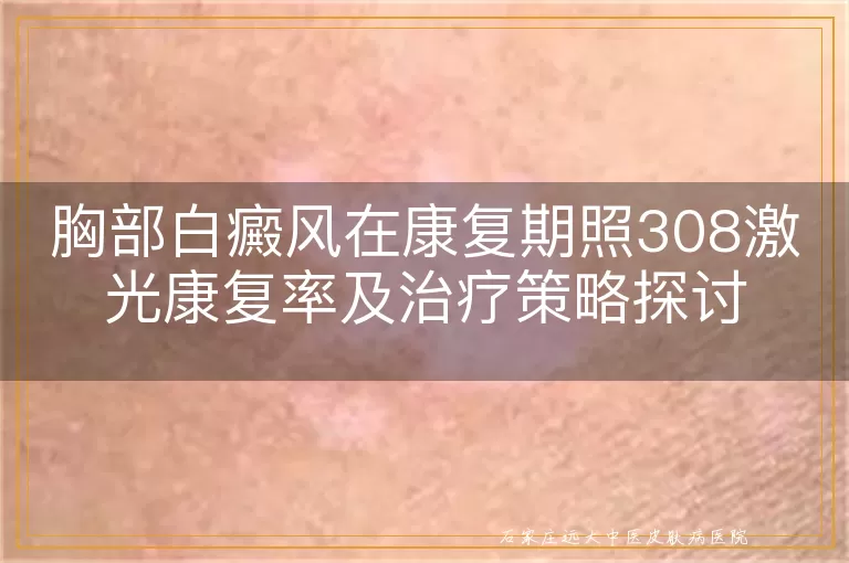 胸部白癜风在康复期照308激光康复率及治疗策略探讨