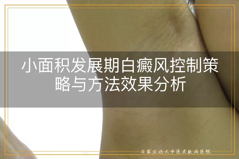 小面积发展期白癜风控制策略与方法效果分析