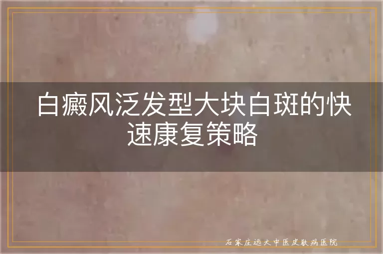 白癜风泛发型大块白斑的快速康复策略
