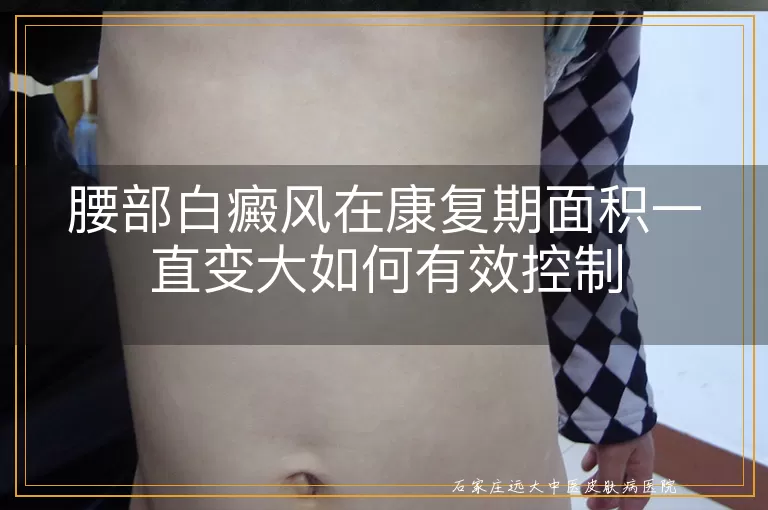 腰部白癜风在康复期面积一直变大如何有效控制