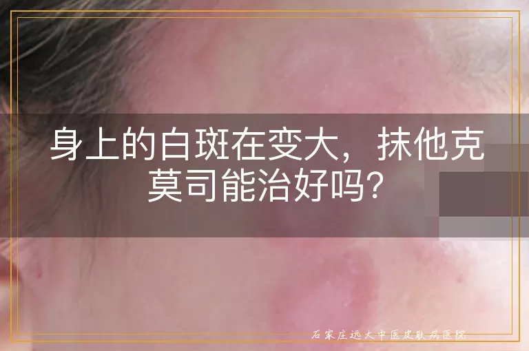 身上的白斑在变大，抹他克莫司能治好吗？