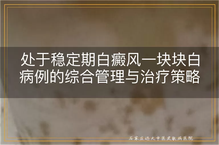 处于稳定期白癜风一块块白病例的综合管理与治疗策略