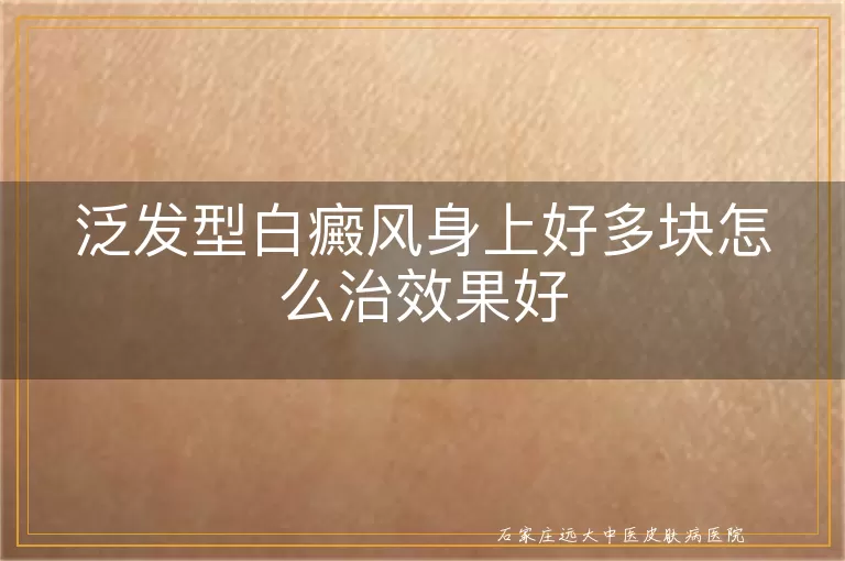 泛发型白癜风身上好多块怎么治效果好