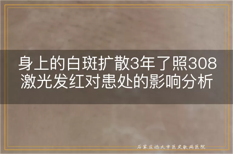 身上的白斑扩散3年了照308激光发红对患处的影响分析