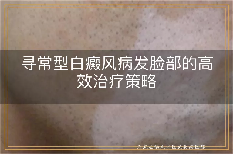 寻常型白癜风病发脸部的高效治疗策略