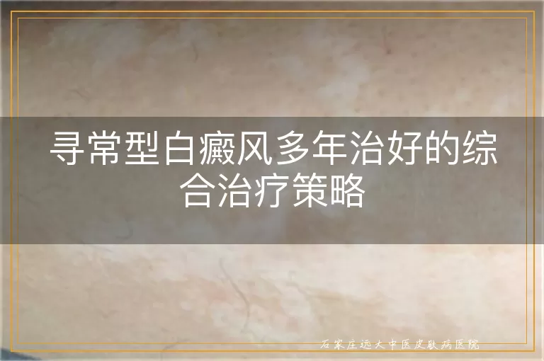 寻常型白癜风多年治好的综合治疗策略
