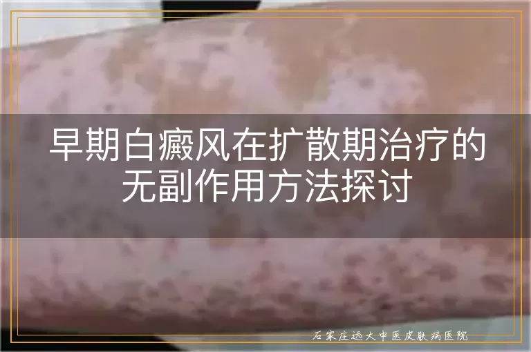 早期白癜风在扩散期治疗的无副作用方法探讨