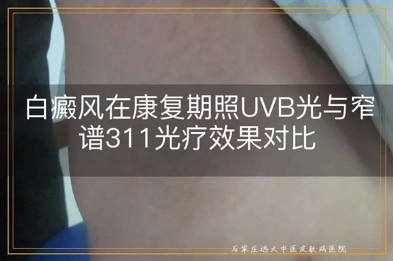 白癜风在康复期照UVB光与窄谱311光疗效果对比