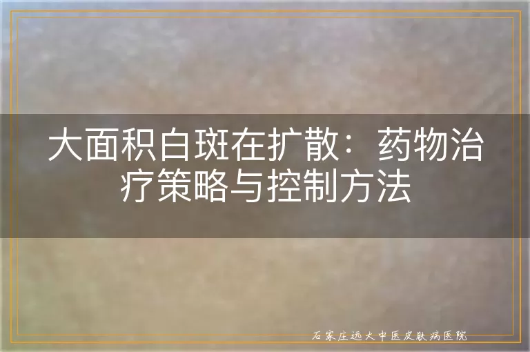 大面积白斑在扩散：药物治疗策略与控制方法