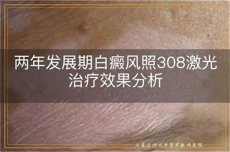 两年发展期白癜风照308激光治疗效果分析