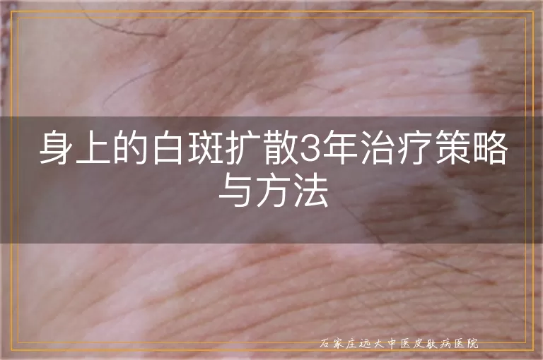 身上的白斑扩散3年治疗策略与方法