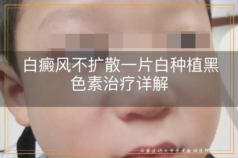 白癜风不扩散一片白种植黑色素治疗详解