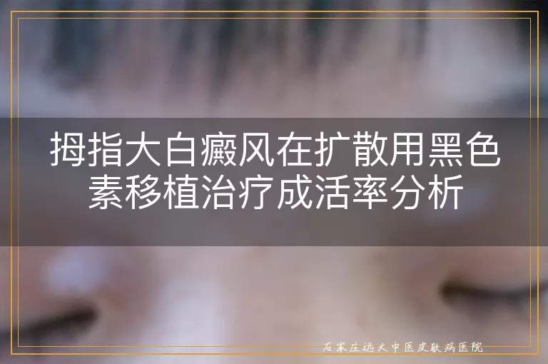 拇指大白癜风在扩散用黑色素移植治疗成活率分析